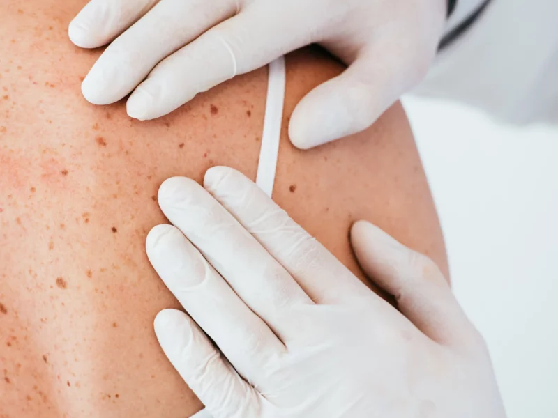 A dermatologist examining a patient’s skin